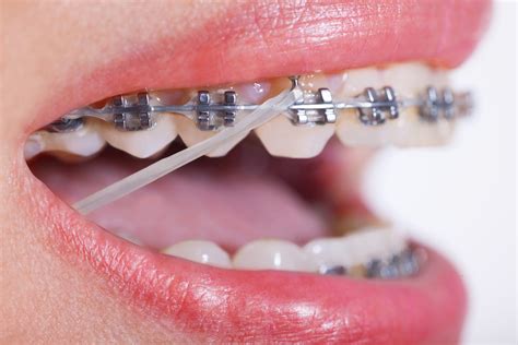 underbite metal bracket rubber bands|rubber band braces for teeth.